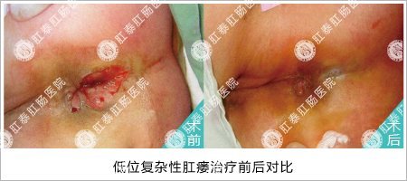 HCPT创口微小术治肛瘘前后对比图