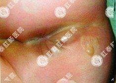 肛瘘流脓
